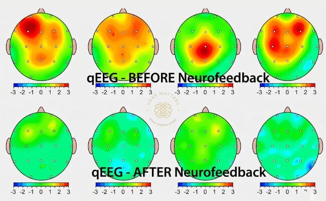 qeeg brain map before and after neurofeedback sessions visual report of qeeg brain map before and after neurofeedback session